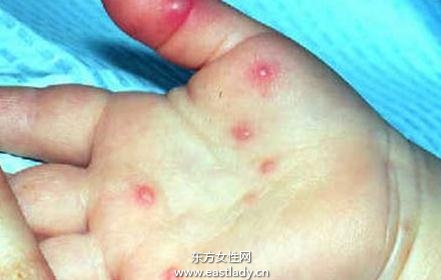 嬰幼兒得皮疹如何護理
