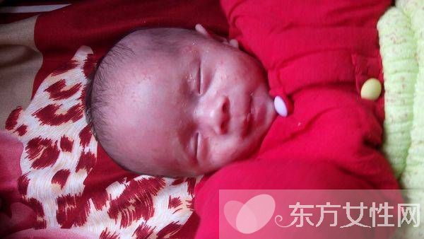 幼兒濕疹治療方法推薦 一定讓寶寶遠離這些東西