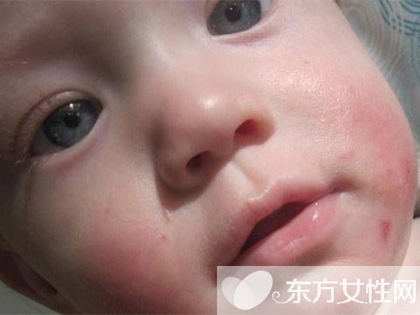 嬰兒奶癬的癥狀表現(xiàn) 這么做可有效預(yù)防奶癬哦