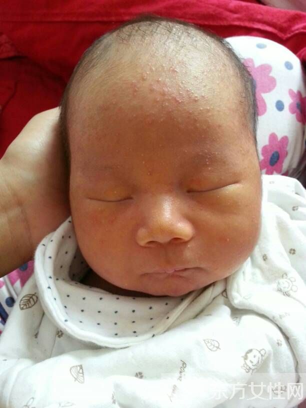 寶寶濕疹最佳治療方法 做好預(yù)防措施讓寶寶健康成長