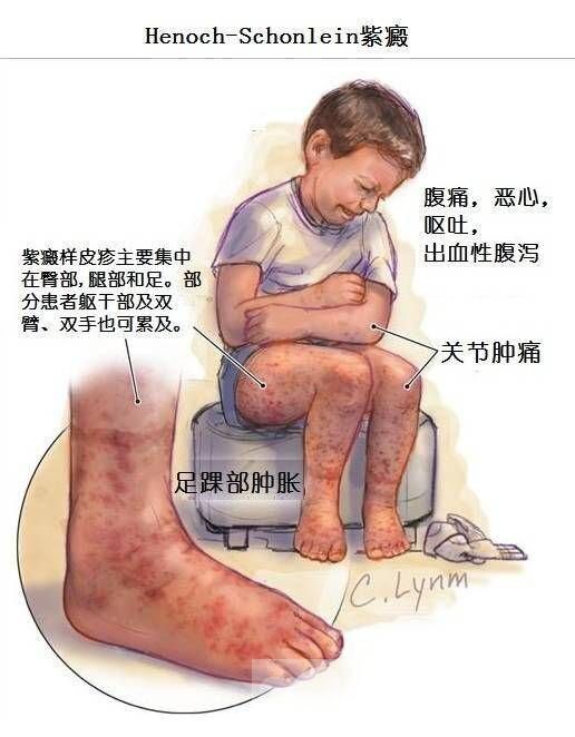 什么是小兒紫癜病 出現(xiàn)這些癥狀千萬不能馬虎