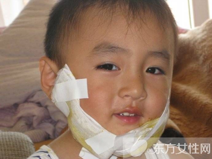 小兒腮腺炎的治療 這些偏方巧治兒童腮腺炎