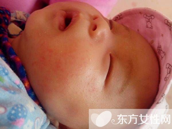 嬰兒奶癬的癥狀表現(xiàn) 這么做可有效預(yù)防奶癬哦