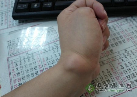 腱鞘炎怎么治療 熏洗法治療腱鞘炎