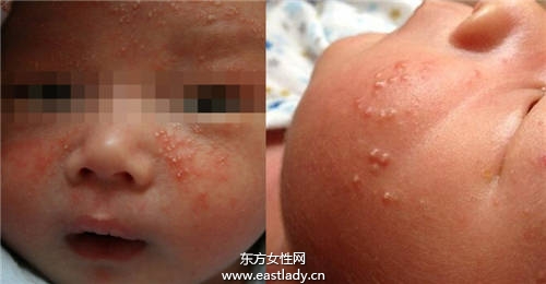 寶寶臉上長(zhǎng)小疙瘩媽媽誤以為是痱子 差點(diǎn)給寶寶毀容