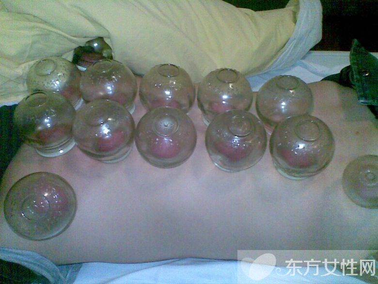 拔火罐減肥的好處與壞處 拔火罐減肥會反彈嗎