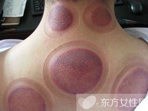 拔火罐減肥的好處與壞處 拔火罐減肥會反彈嗎