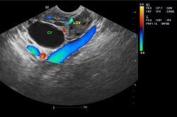 卵巢囊腫的最佳治療 這些不良習(xí)慣易得卵巢囊腫哦