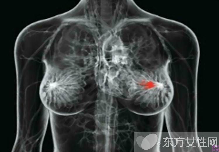 乳腺癌早期癥狀表現(xiàn) 日常如何自查乳腺癌