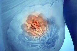 小葉增生癥狀是怎么樣的 引起小葉增生的原因有哪些