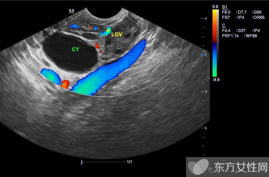 卵巢囊腫的最佳治療 這些不良習(xí)慣易得卵巢囊腫哦