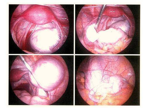 子宮內(nèi)膜異位的癥狀有哪些 專家稱這樣預(yù)防