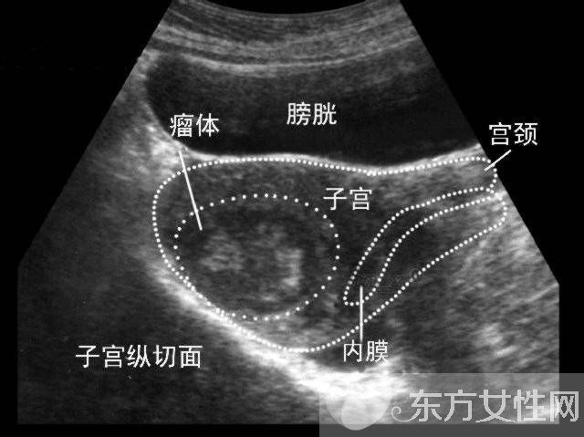子宮肌瘤的癥狀表現(xiàn) 子宮肌瘤的危害居然這么大