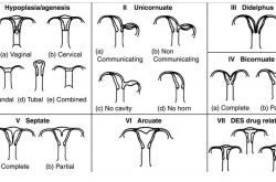 子宮畸形會(huì)引起不孕 這是真的嗎
